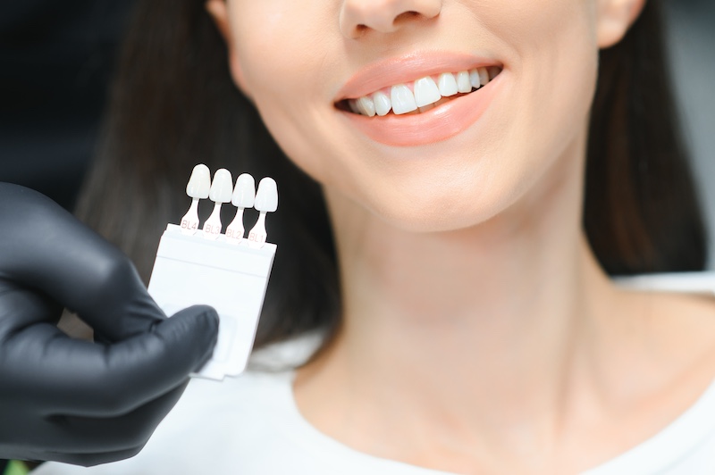 Dental veneers in Acworth