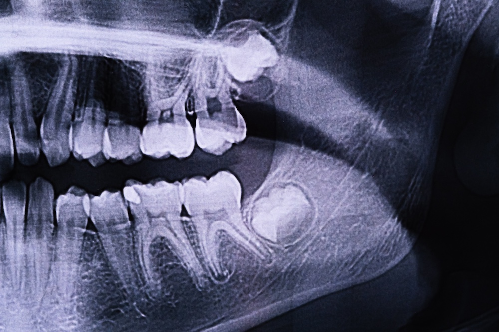 Acworth wisdom teeth extraction